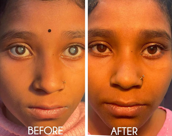 Challenges of Vision Loss in Adolescence!