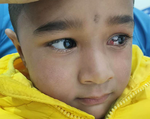 Live Leeches Removed From The Eyes of a 5 Year Old!