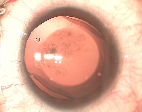 Advance Technology For Challenging Cataract Case